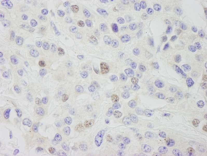 Detection of Human INT11 by Immunohistochemistry. Sample: FFPE section of human breast carcinoma. Antibody: Affinity purified rabbit anti-INT11 used at a dilution of 1:1000 (1 Detection: DAB.