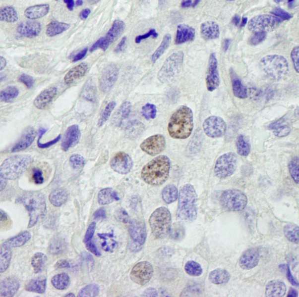 Detection of Human INT11 by Immunohistochemistry. Sample: FFPE section of human breast carcinoma. Antibody: Affinity purified rabbit anti-INT11 used at a dilution of 1:250.