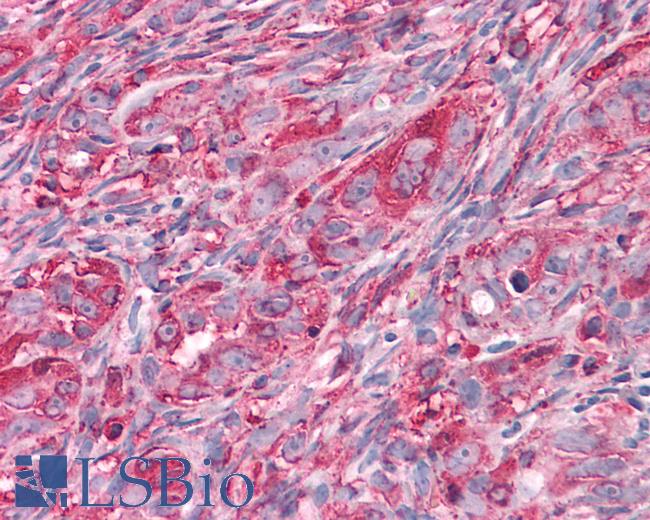Anti-CHRM3 / M3 antibody IHC of human Ovary, Carcinoma. Immunohistochemistry of formalin-fixed, paraffin-embedded tissue after heat-induced antigen retrieval.