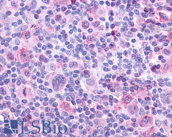 Anti-CHRM4 / M4 antibody IHC of human Lymph Node, Hodgkins Lymphoma. Immunohistochemistry of formalin-fixed, paraffin-embedded tissue after heat-induced antigen retrieval.