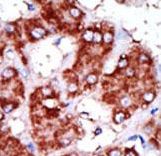 Formalin-fixed and paraffin-embedded human cancer tissue reacted with the primary antibody, which was peroxidase-conjugated to the secondary antibody, followed by DAB staining. This data demonstrates the use of this antibody for immunohistochemistry; clinical relevance has not been evaluated. BC = breast carcinoma; HC = hepatocarcinoma.