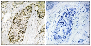 IHC of paraffin-embedded human lung carcinoma tissue, using GA45G Antibody. The picture on the right is treated with the synthesized peptide.