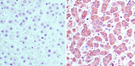 IHC of CRABP2 in formalin-fixed, paraffin-embedded human liver tissue using an isotype control (left) and LS-C148357 (right) at 5 ug/ml.