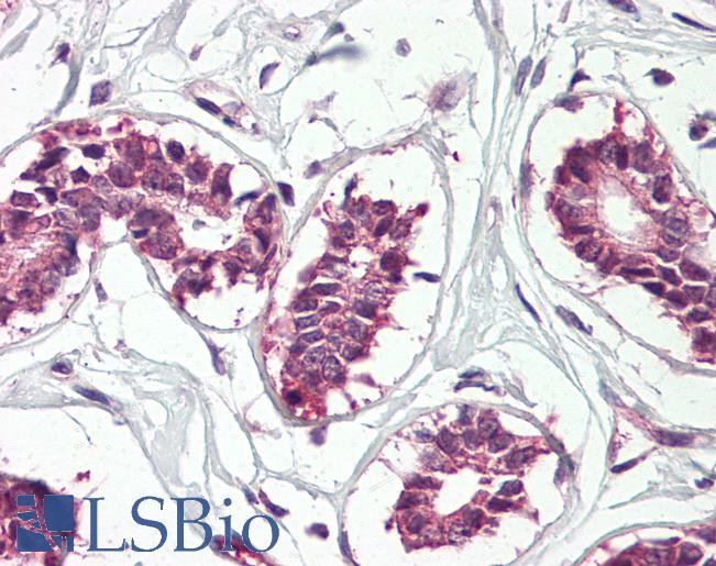 Anti-CRD-BP / IGF2BP1 antibody IHC of human breast. Immunohistochemistry of formalin-fixed, paraffin-embedded tissue after heat-induced antigen retrieval. Antibody LS-B8333 dilution 3.75 ug/ml.