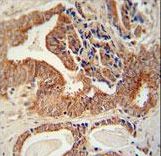 IGF2BP1 antibody immunohistochemistry of formalin-fixed and paraffin-embedded human prostate carcinoma followed by peroxidase-conjugated secondary antibody and DAB staining.