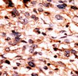 Formalin-fixed and paraffin-embedded human cancer tissue reacted with the primary antibody, which was peroxidase-conjugated to the secondary antibody, followed by AEC staining. This data demonstrates the use of this antibody for immunohistochemistry; clinical relevance has not been evaluated. BC = breast carcinoma; HC = hepatocarcinoma.