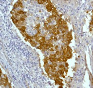 IHC of paraffin-embedded human breast carcinoma using anti-CrkL antibody (LS-C105237).