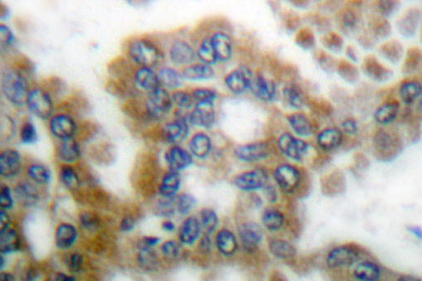 IHC of CrkL (P201) pAb in paraffin-embedded human lung carcinoma tissue.