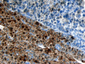 TSLP R in Human Liver. TSLP R was detected in immersion fixed paraffin-embedded sections of human liver using Goat Anti-Human TSLP R Antigen Affinity-purified Polyclonal Antibody at 15 ug/ml overnight at 4°C. Tissue was stained using Anti-Goat HRP-DAB (brown) and counterstained with hematoxylin (blue).