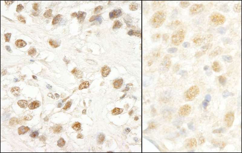Detection of Human and Mouse CROP/Luc7A by Immunohistochemistry. Sample: FFPE section of human testicular seminoma (left) and mouse colon carcinoma (right). Antibody: Affinity purified rabbit anti-CROP/Luc7A used at a dilution of 1:1000 (1 ug/ml). Detection: DAB.