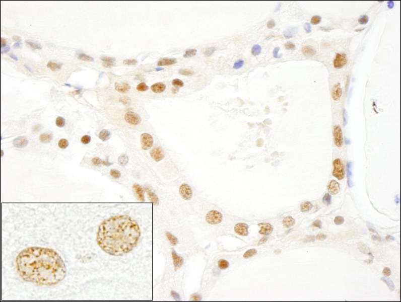 Detection of Human CROP/Luc7A by Immunohistochemistry. Sample: FFPE section of human thyroid carcinoma. Antibody: Affinity purified rabbit anti-CROP/Luc7A used at a dilution of 1:250.