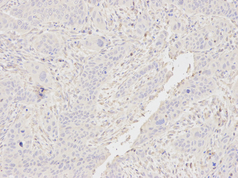 Immunohistochemistry of paraffin-embedded human esophageal cancer using CSRP1 antibody at dilution of 1:400 (200x lens).
