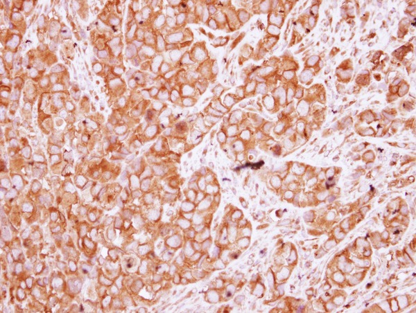 IHC of paraffin-embedded H661 xenograft, using Nicotinic Acetylcholine Receptor beta antibody at 1:250 dilution.