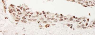Detection of Human TORC2 by Immunohistochemistry. Sample: FFPE section of human prostate carcinoma. Antibody: Affinity purified rabbit anti- TORC2 used at a dilution of 1:1000 (1 Detection: DAB.