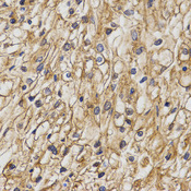 Immunohistochemistry of paraffin-embedded human kidney cancer using CHRNB1 antibody at dilution of 1:200 (x400 lens)