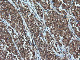 IHC of paraffin-embedded Carcinoma of Human thyroid tissue using anti-CRYAA mouse monoclonal antibody. (Heat-induced epitope retrieval by 10mM citric buffer, pH6.0, 100C for 10min).