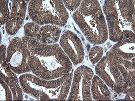 IHC of paraffin-embedded Adenocarcinoma of Human endometrium tissue using anti-CRYAA mouse monoclonal antibody. (Heat-induced epitope retrieval by 10mM citric buffer, pH6.0, 100C for 10min).