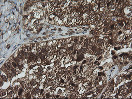 IHC of paraffin-embedded Adenocarcinoma of Human ovary tissue using anti-CRYAA mouse monoclonal antibody. (Heat-induced epitope retrieval by 10mM citric buffer, pH6.0, 100C for 10min).