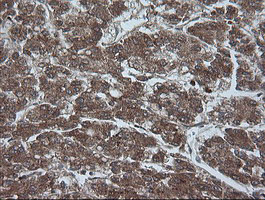 IHC of paraffin-embedded Carcinoma of Human liver tissue using anti-CRYAA mouse monoclonal antibody. (Heat-induced epitope retrieval by 10mM citric buffer, pH6.0, 100C for 10min).