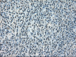 IHC of paraffin-embedded lymphoma tissue using anti-CRYAB mouse monoclonal antibody. (Dilution 1:50).