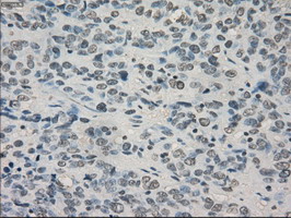 IHC of paraffin-embedded Carcinoma of bladder tissue using anti-CRYAB mouse monoclonal antibody. (Dilution 1:50).