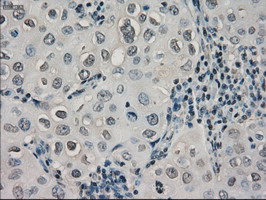 IHC of paraffin-embedded Adenocarcinoma of breast tissue using anti-CRYAB mouse monoclonal antibody. (Dilution 1:50).