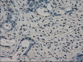 IHC of paraffin-embedded Adenocarcinoma of colon tissue using anti-CRYAB mouse monoclonal antibody. (Dilution 1:50).