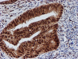 IHC of paraffin-embedded Adenocarcinoma of Human endometrium tissue using anti-CRYZL1 mouse monoclonal antibody. (Heat-induced epitope retrieval by 10mM citric buffer, pH6.0, 100C for 10min).