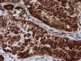 IHC of paraffin-embedded Adenocarcinoma of Human ovary tissue using anti-CRYZL1 mouse monoclonal antibody. (Heat-induced epitope retrieval by 10mM citric buffer, pH6.0, 100C for 10min).
