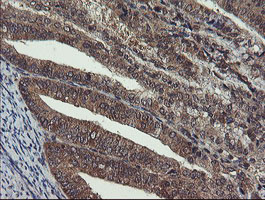 IHC of paraffin-embedded Adenocarcinoma of Human endometrium tissue using anti-CRYZL1 mouse monoclonal antibody.