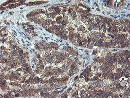 IHC of paraffin-embedded Adenocarcinoma of Human ovary tissue using anti-CRYZL1 mouse monoclonal antibody.