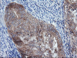 IHC of paraffin-embedded Adenocarcinoma of Human endometrium tissue using anti-CRYZL1 mouse monoclonal antibody.
