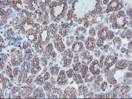 IHC of paraffin-embedded Carcinoma of Human thyroid tissue using anti-CRYZL1 mouse monoclonal antibody.