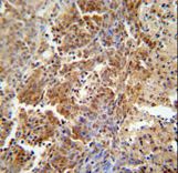 ERCC8 antibody immunohistochemistry of formalin-fixed and paraffin-embedded human lung carcinoma followed by peroxidase-conjugated secondary antibody and DAB staining.