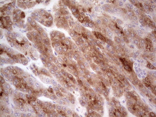 IHC of paraffin-embedded Carcinoma of Human liver tissue using anti-CSF1 mouse monoclonal antibody. (heat-induced epitope retrieval by 1 mM EDTA in 10mM Tris, pH8.5, 120°C for 3min).