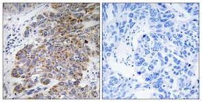IHC of paraffin-embedded human lung carcinoma tissue, using CHST10 Antibody. The picture on the right is treated with the synthesized peptide.