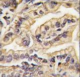 Formalin-fixed and paraffin-embedded human lung carcinoma tissue reacted with CSF1R Antibody , which was peroxidase-conjugated to the secondary antibody, followed by DAB staining. This data demonstrates the use of this antibody for immunohistochemistry; clinical relevance has not been evaluated.