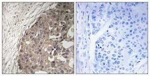 IHC of paraffin-embedded human breast carcinoma tissue, using CSGALNACT1 Antibody. The picture on the right is treated with the synthesized peptide.