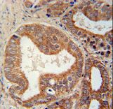 CSGALNACT1 Antibody immunohistochemistry of formalin-fixed and paraffin-embedded human prostate carcinoma followed by peroxidase-conjugated secondary antibody and DAB staining. This data demonstrates the use of the CSGALNACT1 Antibody for immunohistochemistry.