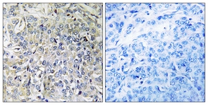 IHC of paraffin-embedded human breast carcinoma tissue, using CSGALNACT2 Antibody. The sample on the right was incubated with synthetic peptide.
