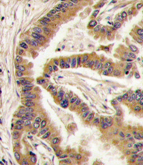 Formalin-fixed and paraffin-embedded human lung carcinoma tissue reacted with CK1a antibody , which was peroxidase-conjugated to the secondary antibody, followed by DAB staining. This data demonstrates the use of this antibody for immunohistochemistry; clinical relevance has not been evaluated.