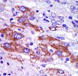 Formalin-fixed and paraffin-embedded human cancer tissue reacted with the primary antibody, which was peroxidase-conjugated to the secondary antibody, followed by DAB staining. This data demonstrates the use of this antibody for immunohistochemistry; clinical relevance has not been evaluated. BC = breast carcinoma; HC = hepatocarcinoma.