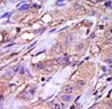 Formalin-fixed and paraffin-embedded human cancer tissue reacted with the primary antibody, which was peroxidase-conjugated to the secondary antibody, followed by DAB staining. This data demonstrates the use of this antibody for immunohistochemistry; clinical relevance has not been evaluated. BC = breast carcinoma; HC = hepatocarcinoma.
