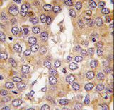 Formalin-fixed and paraffin-embedded human hepatocarcinoma tissue reacted with CK1g2 antibody , which was peroxidase-conjugated to the secondary antibody, followed by DAB staining. This data demonstrates the use of this antibody for immunohistochemistry; clinical relevance has not been evaluated.
