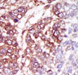 Formalin-fixed and paraffin-embedded human cancer tissue reacted with the primary antibody, which was peroxidase-conjugated to the secondary antibody, followed by DAB staining. This data demonstrates the use of this antibody for immunohistochemistry; clinical relevance has not been evaluated. BC = breast carcinoma; HC = hepatocarcinoma.