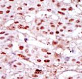 Formalin-fixed and paraffin-embedded human cancer tissue reacted with the primary antibody, which was peroxidase-conjugated to the secondary antibody, followed by DAB staining. This data demonstrates the use of this antibody for immunohistochemistry; clinical relevance has not been evaluated. BC = breast carcinoma
