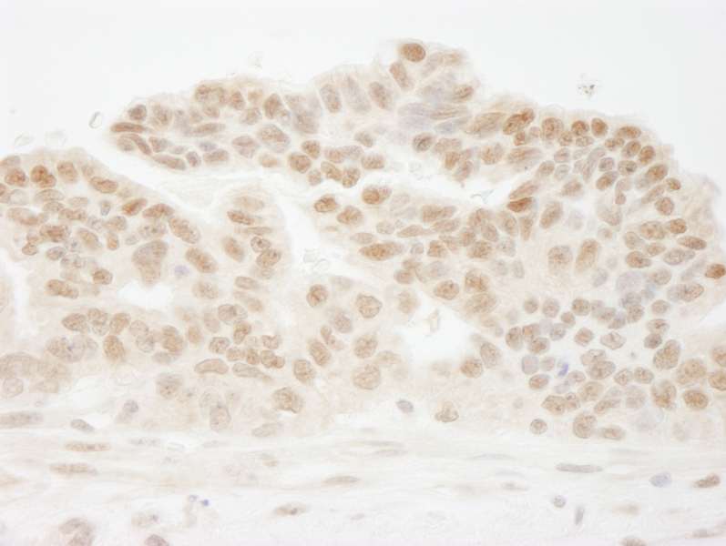 Detection of Human CSTF50 by Immunohistochemistry. Sample: FFPE section of human ovarian carcinoma. Antibody: Affinity purified rabbit anti-CSTF50 used at a dilution of 1:250.