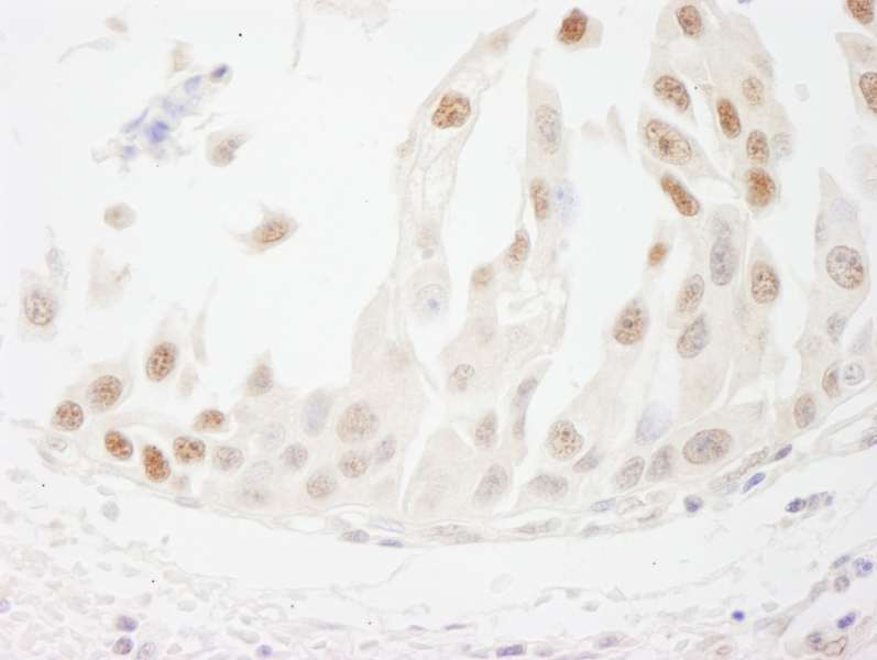 Detection of Human CSTF50 by Immunohistochemistry. Sample: FFPE section of human bladder cell carcinoma. Antibody: Affinity purified rabbit anti-CSTF50 used at a dilution of 1:1000 (1 ug/ml). Detection: DAB.