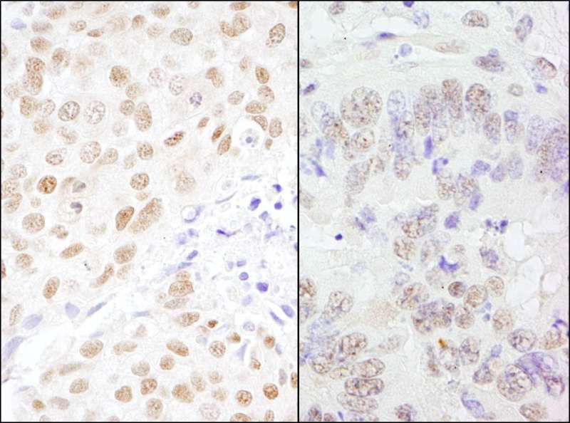 Detection of Human and Mouse CSTF77 by Immunohistochemistry. Sample: FFPE section of human breast carcinoma (left) and mouse teratoma (right). Antibody: Affinity purified rabbit anti-CSTF77 used at a dilution of 1:200 (1 ug/ml). Detection: DAB.
