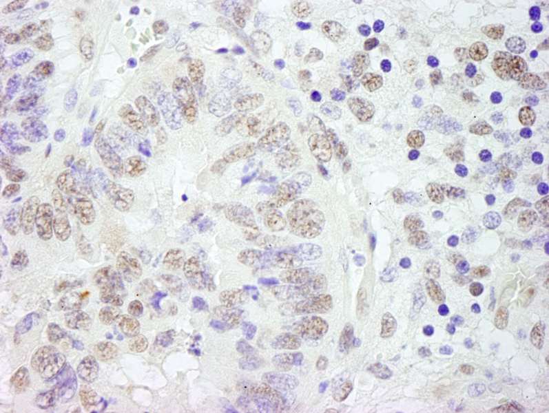 Detection of Mouse CSTF77 by Immunohistochemistry. Sample: FFPE section of mouse teratoma. Antibody: Affinity purified rabbit anti-CSTF77 used at a dilution of 1:250.